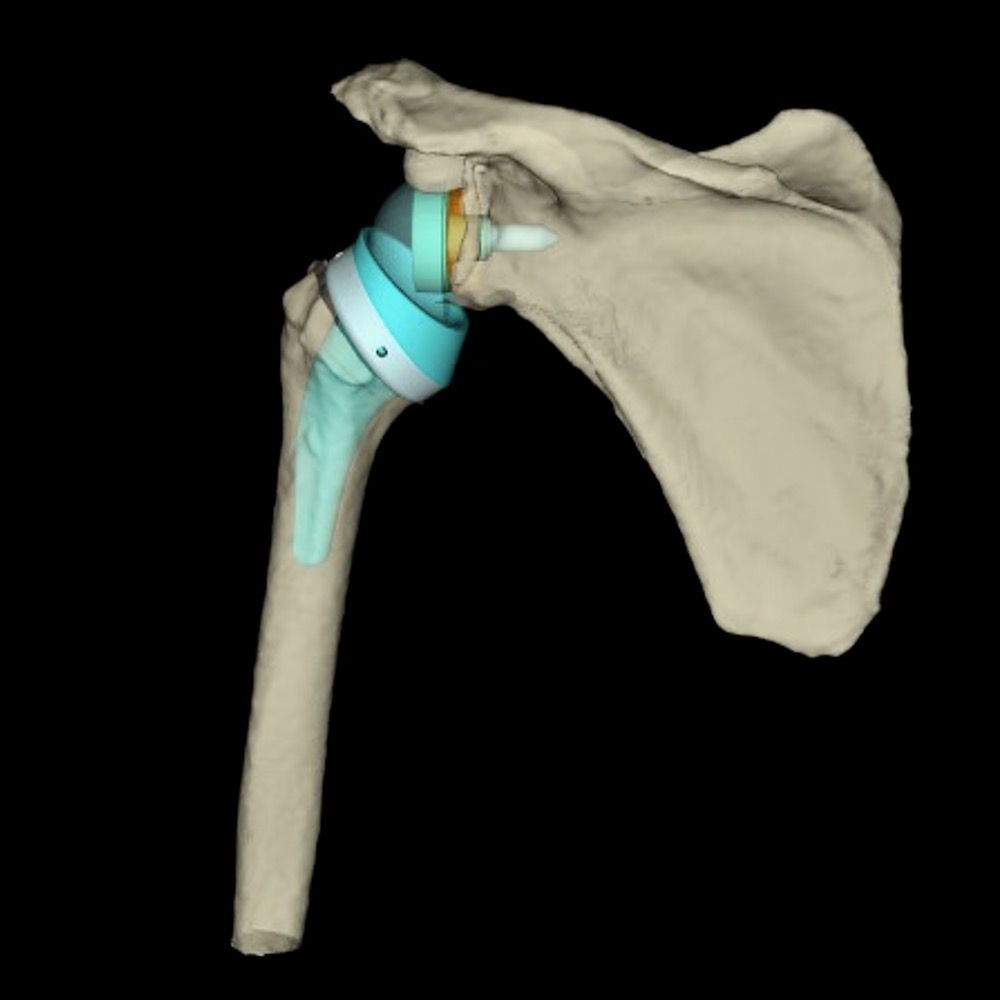 3D-Planung inverse Schulterprothese