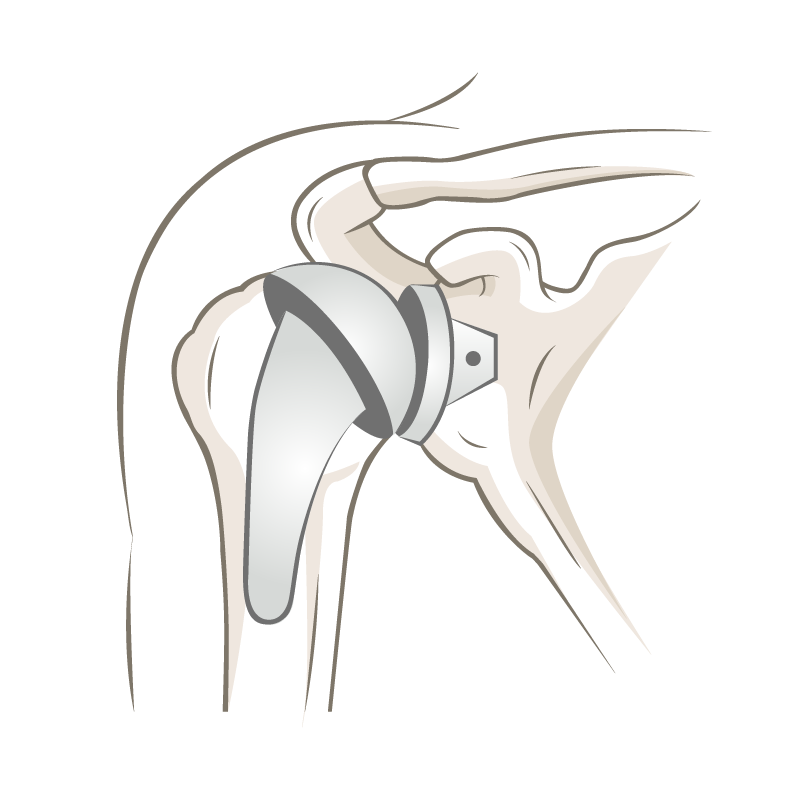 Anatomische Schulterprothese