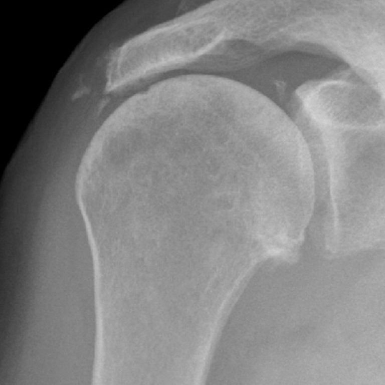 Arthrose, Schulter Gelenkzentrum Zürich, Bethanien