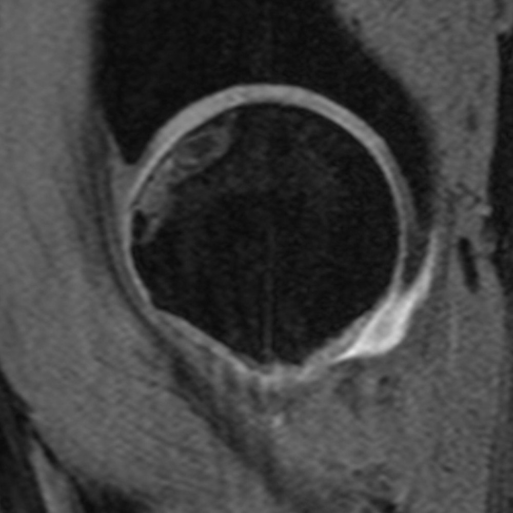Sagittaler MRI Schnitt durch das Hüftgelenk des gleichen Patienten mit kleiner vorne oben liegender Hüftkopfnekrose