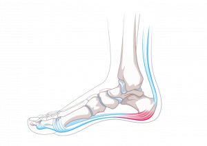 Fersenschmerz, Fuss | Gelenkzentrum Zürich, Bethanien