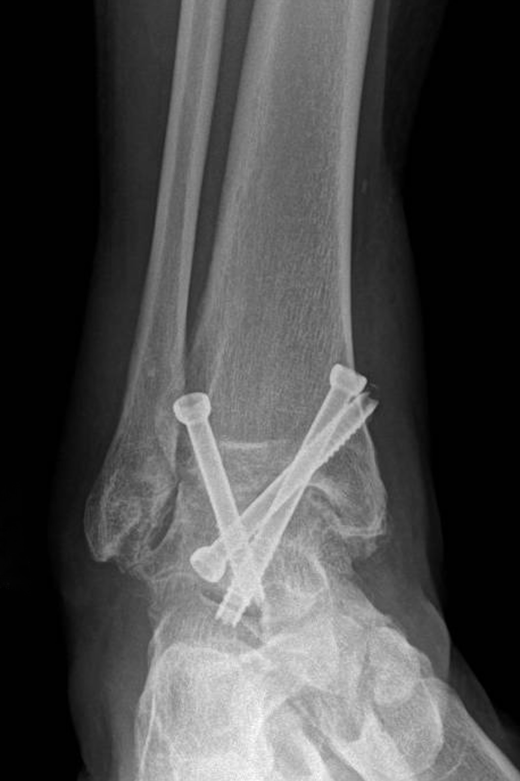 Versteifung (Arthrodese) der Knochen im Sprunggelenk