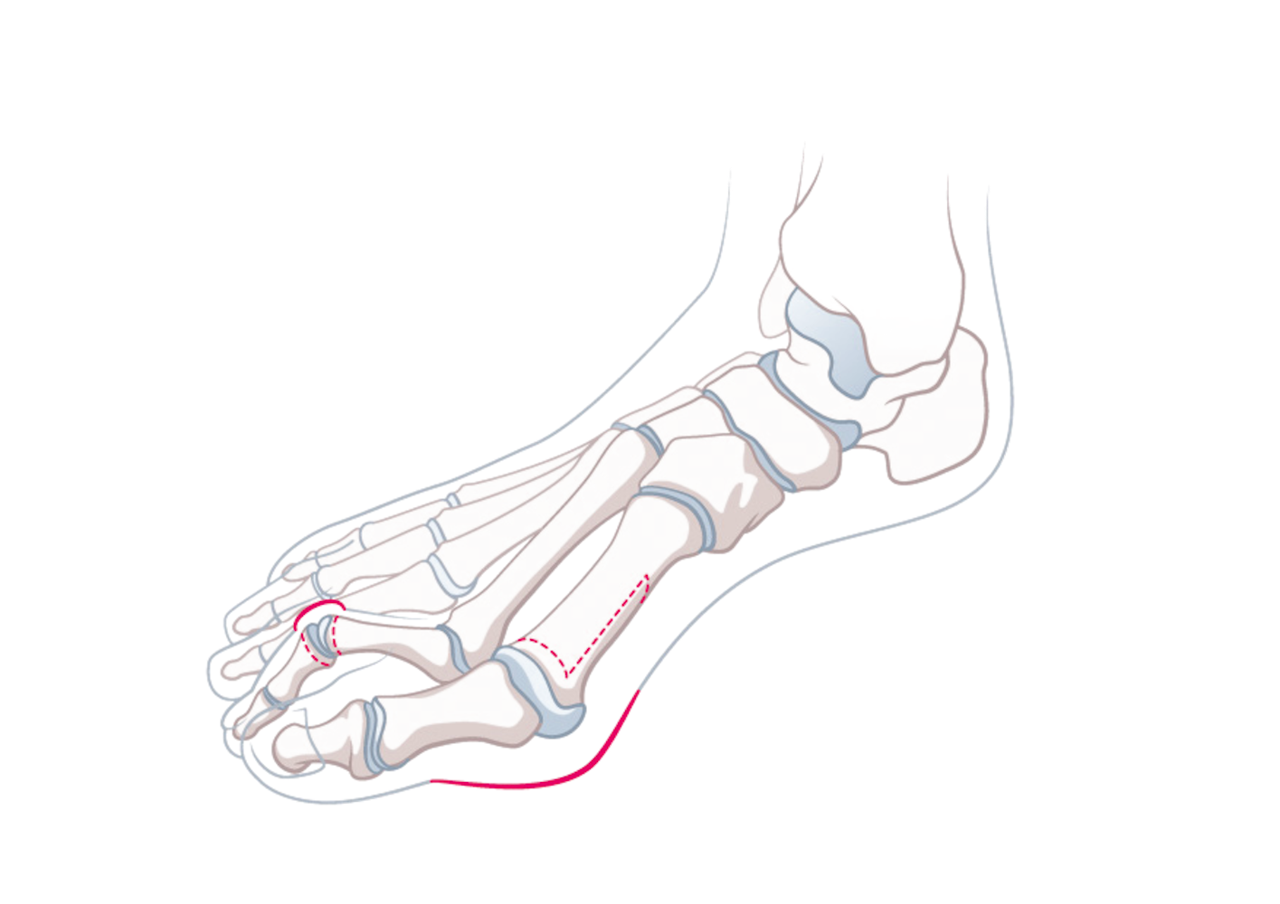 Hallux-Osteotomie-A