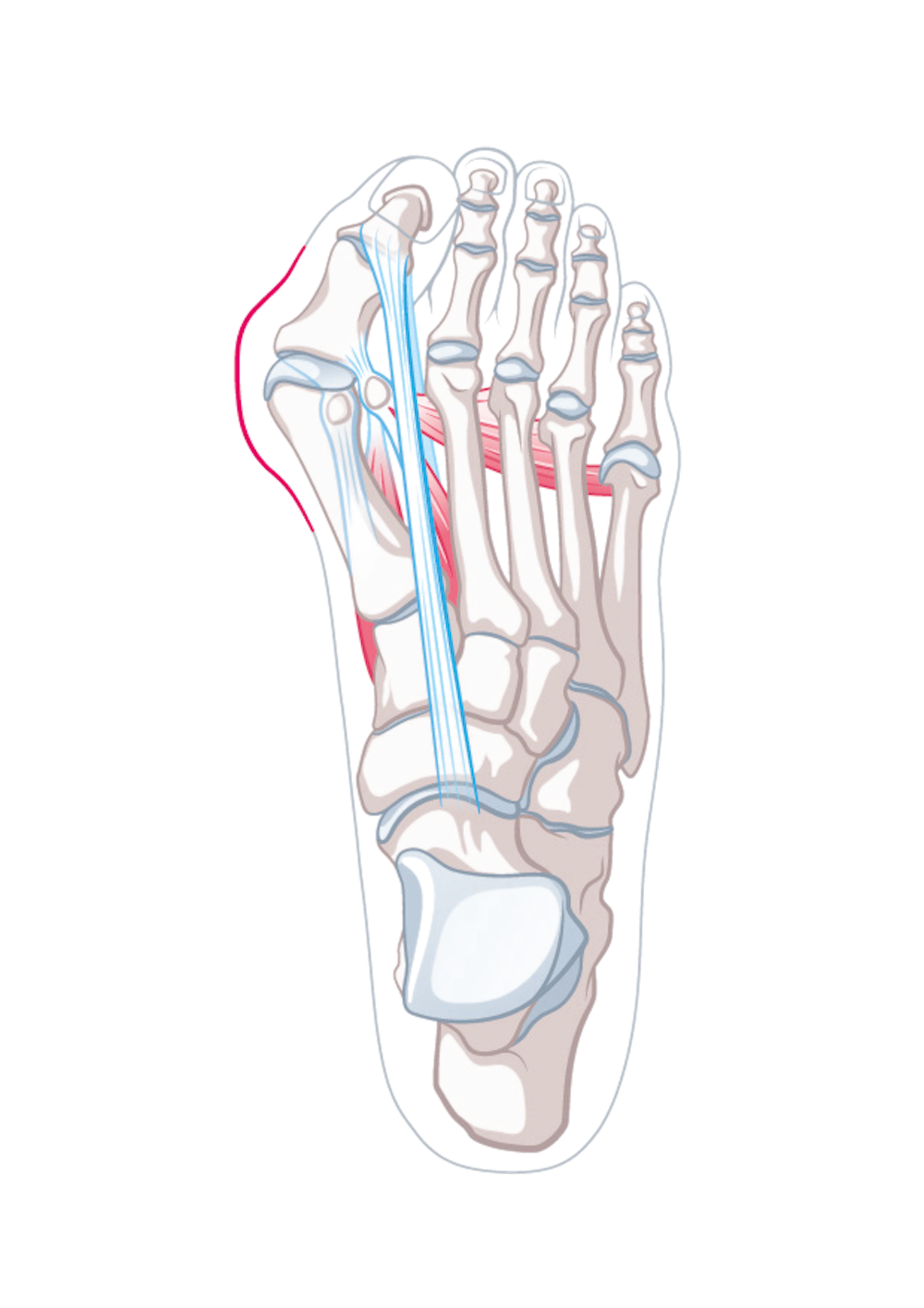 Hallux_Uebersicht