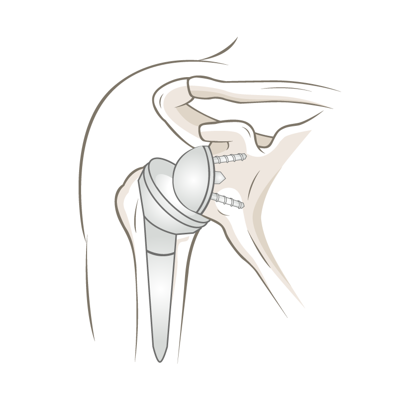 Inverse Schulterprothese