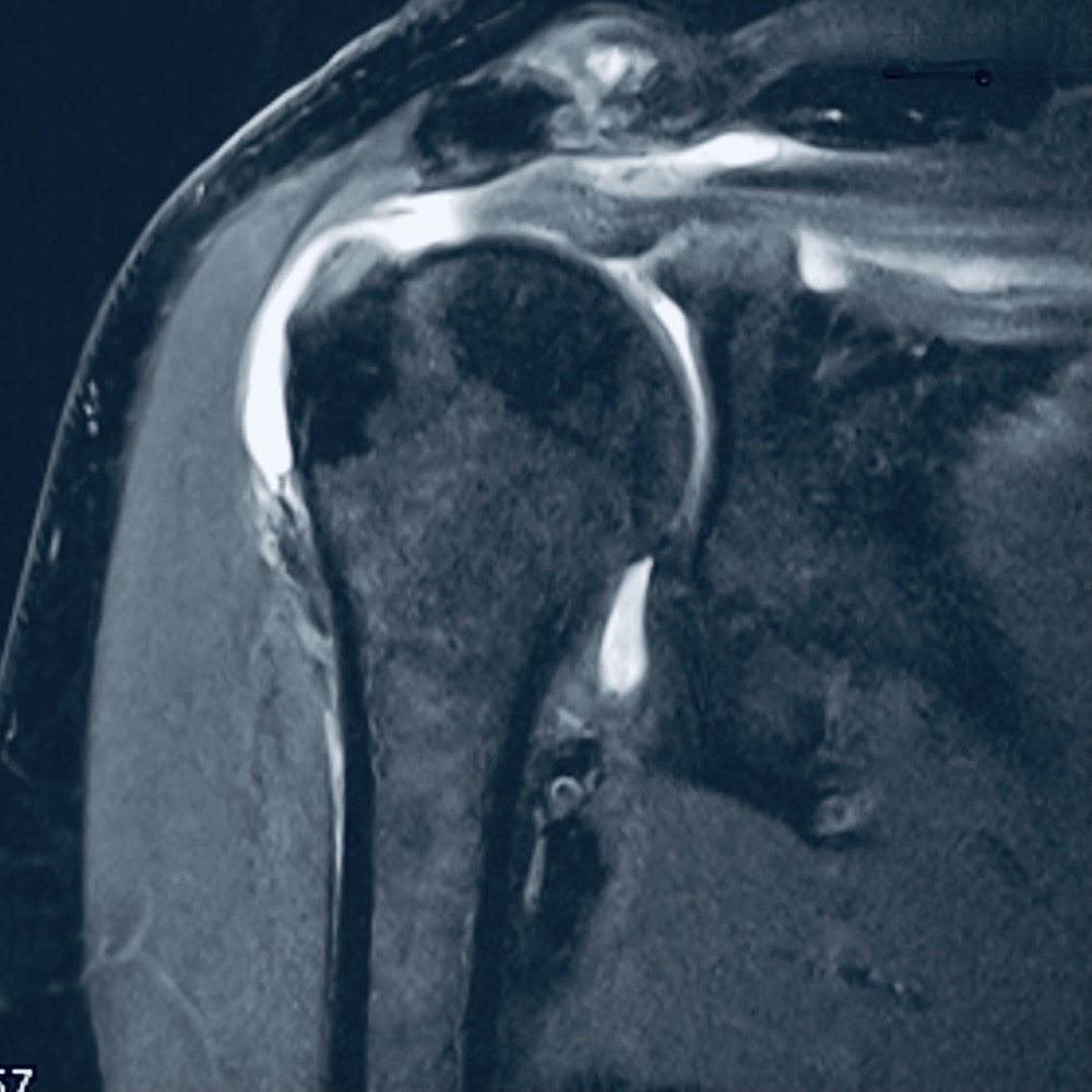 MRI mit Riss der Supraspinatussehne