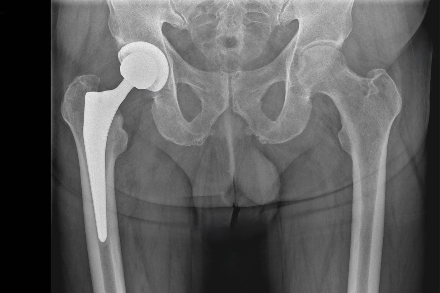 Beispiel eines Röntgenbildes einer optimal eingesetzten Hüftprothese rechts (Patientenseite).