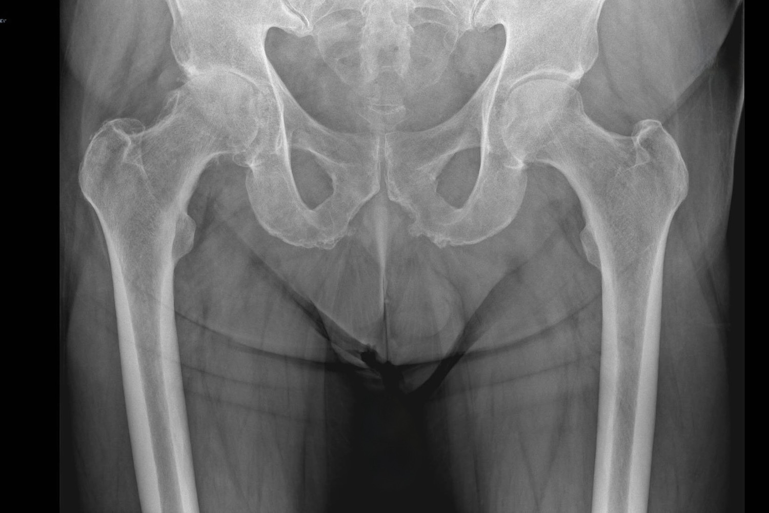 Beispiel eines Röntgenbildes mit einer Hüftarthrose rechts (Patientenseite) mit komplett aufgehobenem Gelenkspalt.