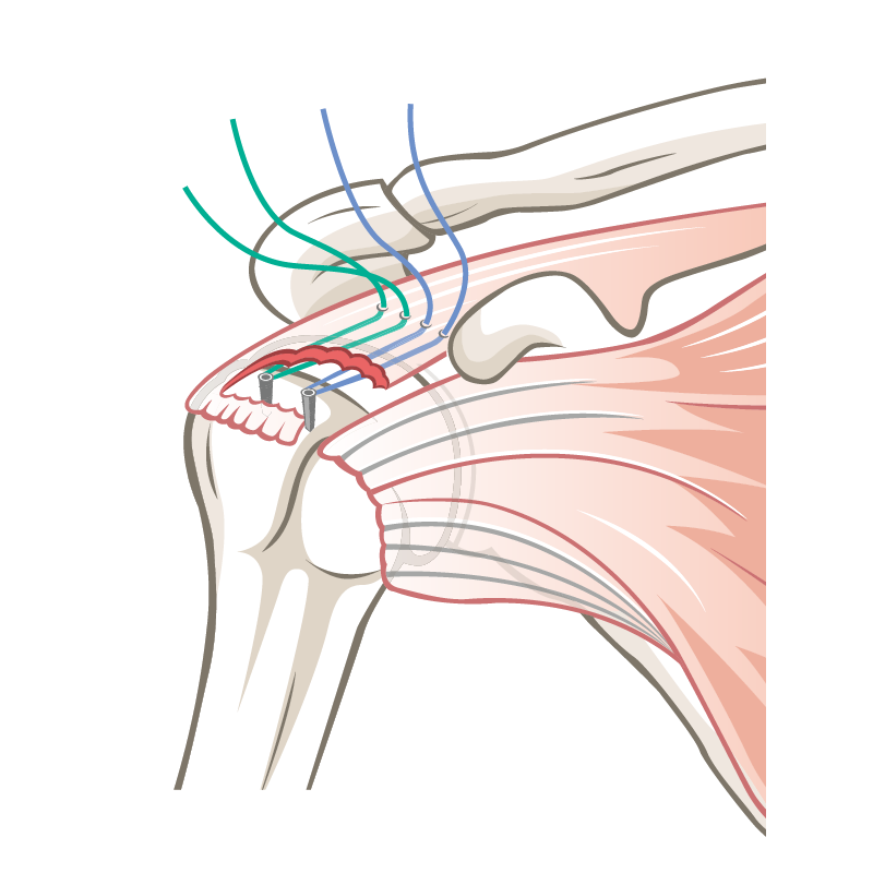 Rekonstruktion der Rotatorenmanschette mit Fadenanker