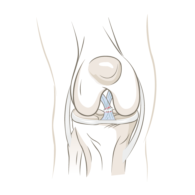 Verletzungen des vorderen Kreuzbandes