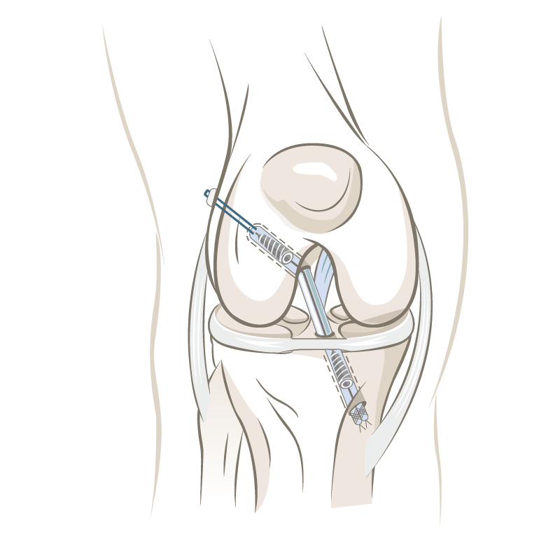 repair anterior cruciate ligament ACL