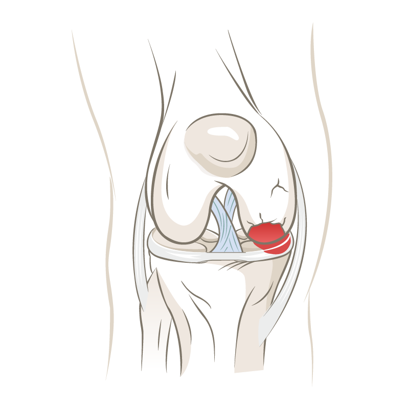 teilweise Arthrose im Knie