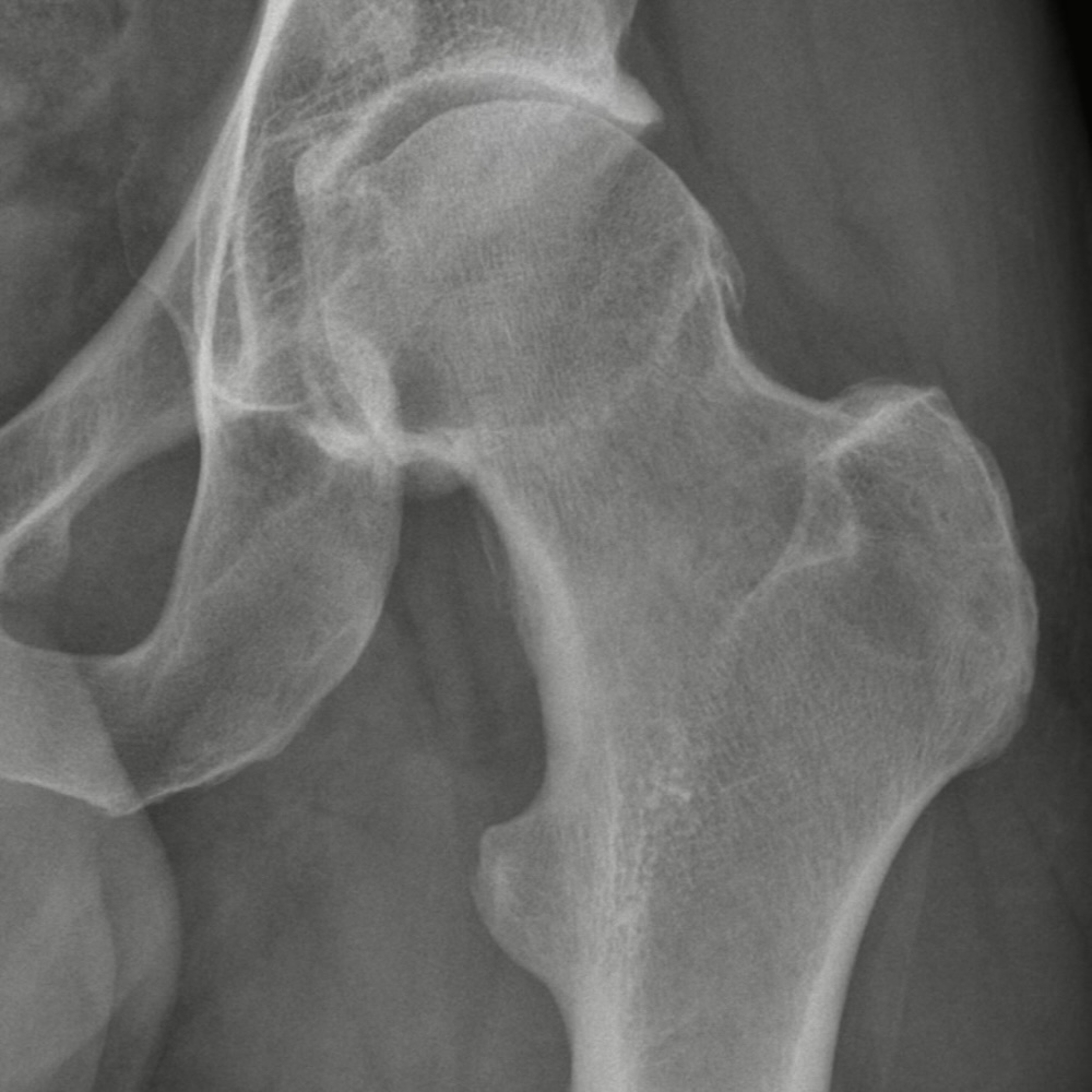 Hüftarthrose bei einem 40-jährigen aktiven Patienten