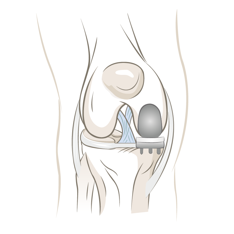 Knieteilprothese