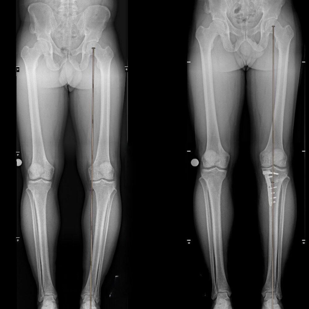 Korrektur der Beinachse (rechtes Röntgenbild)